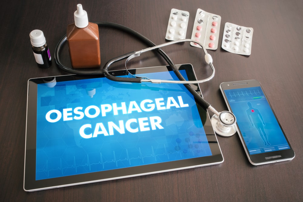 oesophageal-cancer-treatment