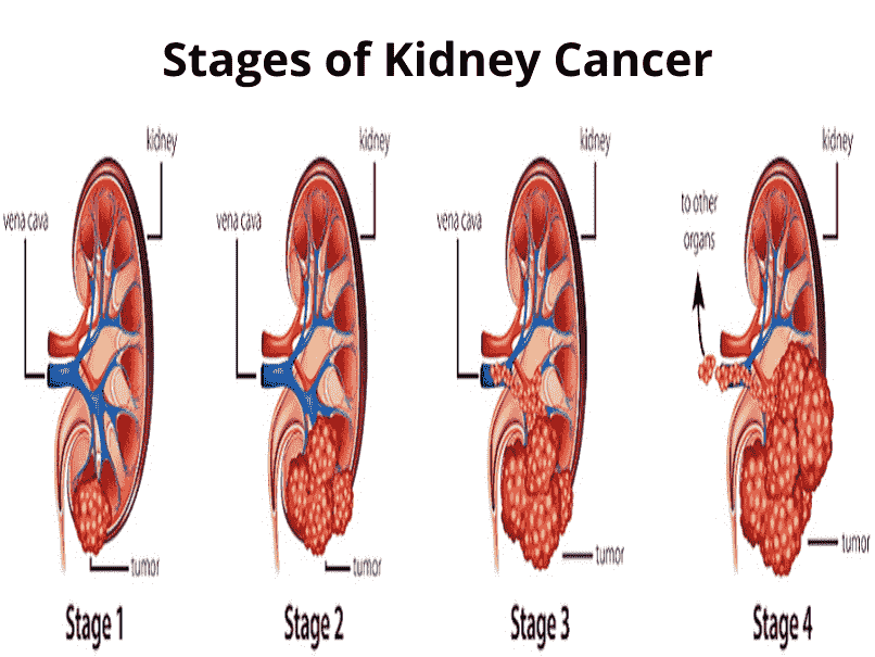 You Need To Know About Stages Of Kidney Cancer Dr Rudra Acharya